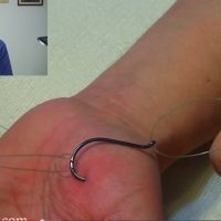 5 Ways To Remove A Fish Hook Buried Deeply In Your Skin - Walden Labs